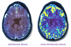 Why TMS Therapy?